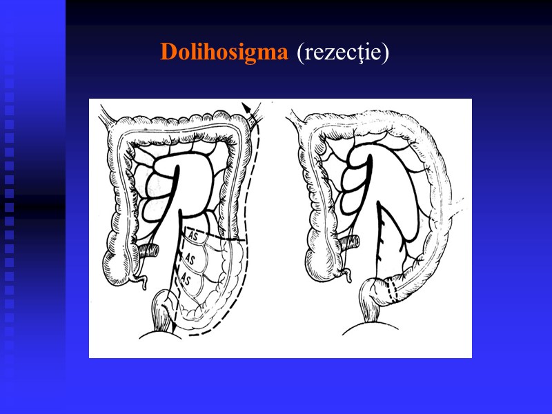 Dolihosigma (rezecţie)